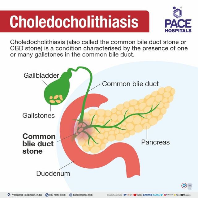 Stone in bile deals duct